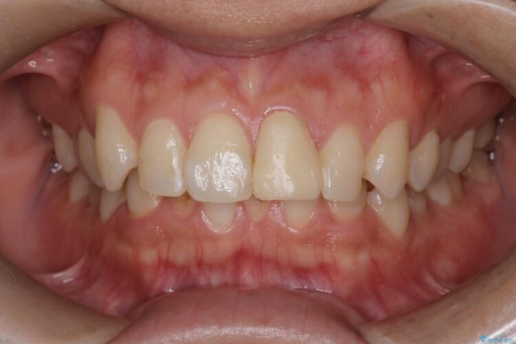 インビザラインとセラミックで前歯を美しく ビフォー