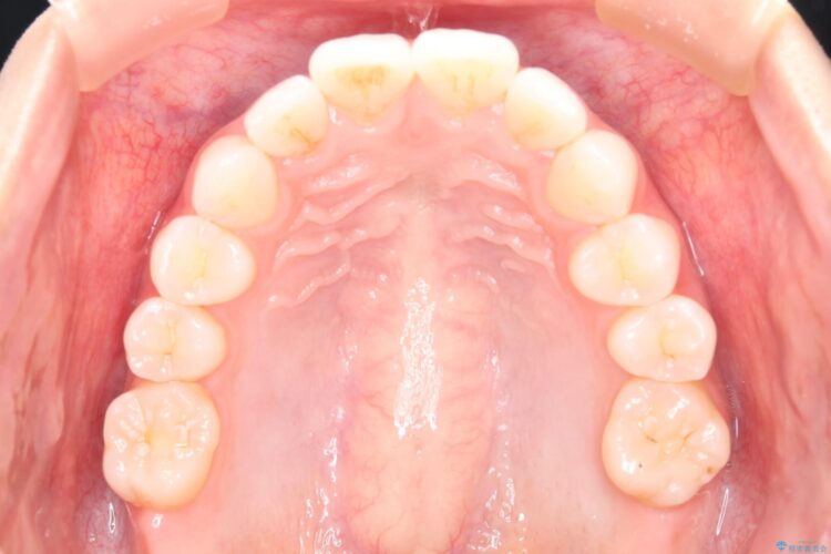 突出した前歯をインビザラインで改善 治療前画像