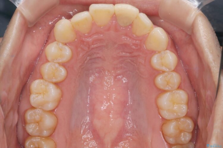 インビザラインとセラミックで前歯を美しく 治療前画像