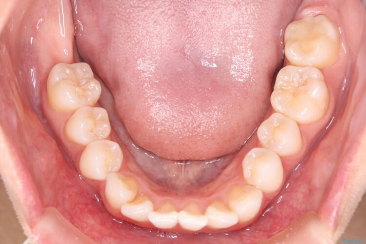 突出した前歯をインビザラインで改善 治療前画像