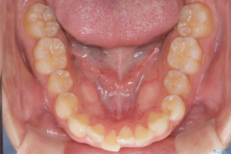 インビザラインとセラミックで前歯を美しく 治療前画像