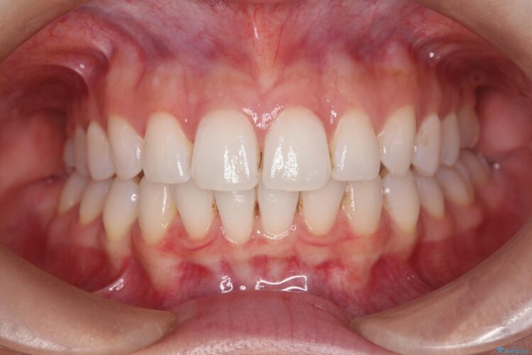 突出した前歯をインビザラインで改善 アフター