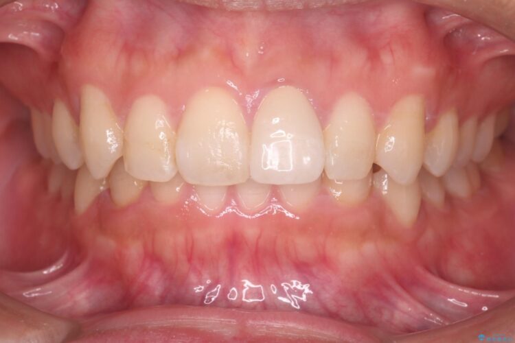 インビザラインとセラミックで前歯を美しく アフター