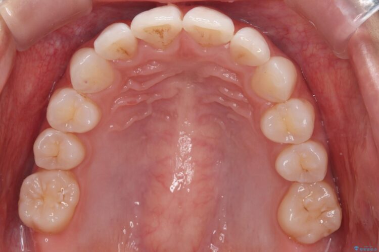 突出した前歯をインビザラインで改善 治療後画像