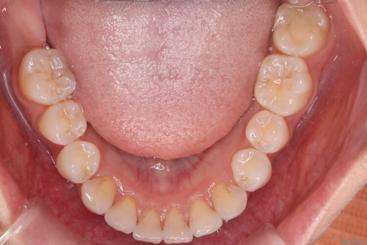 突出した前歯をインビザラインで改善 治療後画像