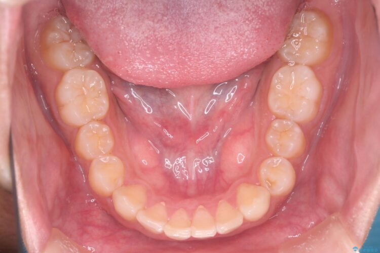 インビザラインとセラミックで前歯を美しく 治療後画像